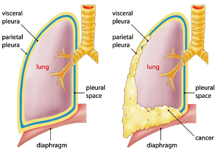 Bệnh u màng phổi và những điều cần biết!