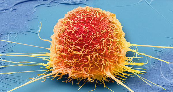 Cắt bỏ khối u có điều trị dứt điểm được bệnh ung thư dạ dày không? Chuyên gia Phan Văn Dân tư vấn