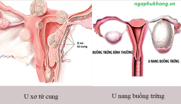 BỊ U XƠ TỬ CUNG, U NANG BUỒNG TRỨNG SỬ DỤNG SẢN PHẨM THẢO DƯỢC CÓ TỐT KHÔNG?