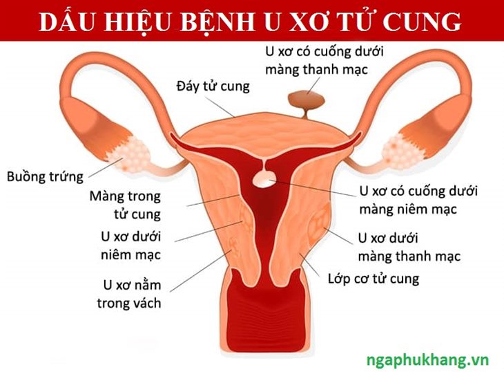 Bạn đã biết 5 dấu hiệu bệnh u xơ tử cung thường gặp này chưa?