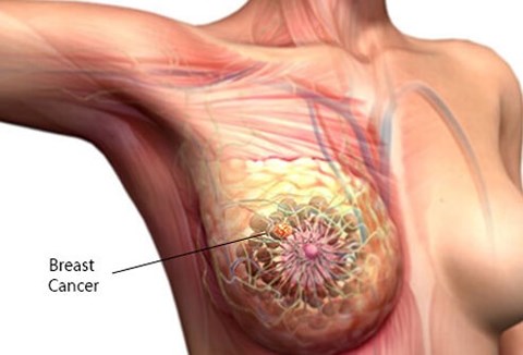 Bị ung thư vú và đang xạ trị có dùng Oncolysin kết hợp hỗ trợ điều trị được không?