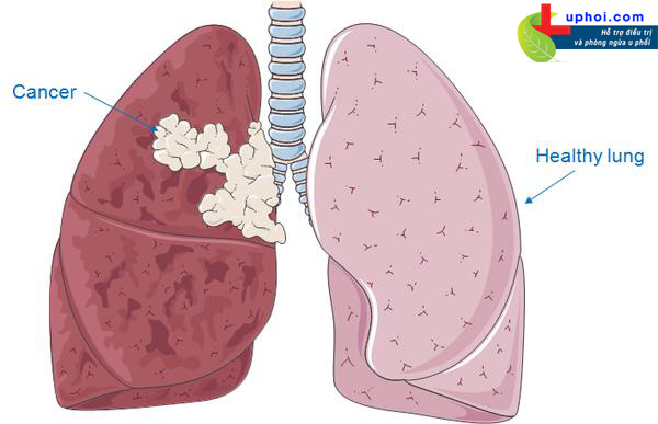 Ung thư phổi thứ phát là gì và điều trị như thế nào?