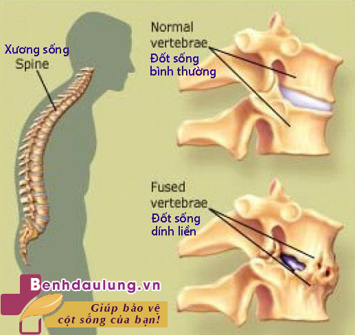 Vì sao hàng triệu người sử dụng Cốt Thoái Vương khi bị bệnh viêm cột sống dính khớp?