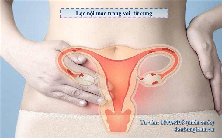 Phụ nữ mắc bệnh lạc nội mạc tử cung có cơ hội làm mẹ không?