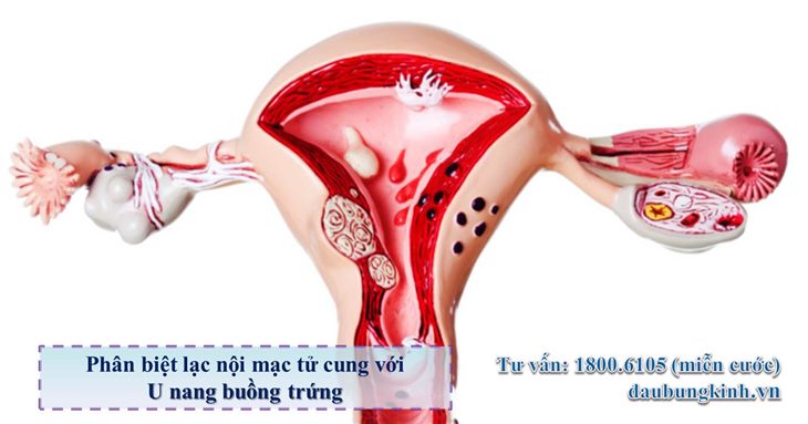 Lạc nội mạc tử cung là gì? Phân biệt với u nang buồng trứng ra sao?