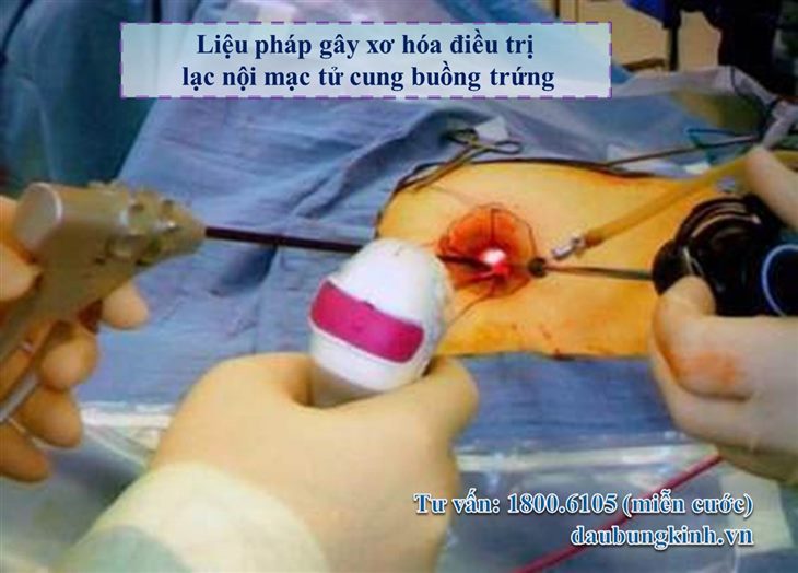 Liệu pháp gây xơ hóa điều trị lạc nội mạc tử cung buồng trứng có ưu điểm gì?