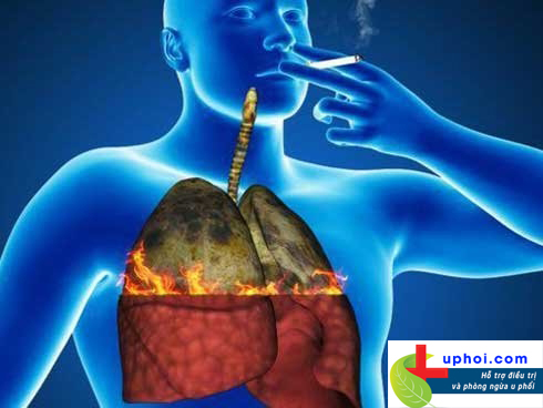 Ung thư phổi có nguy hiểm không? Đọc ngay để biết!