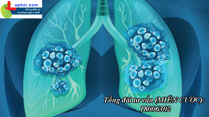 Ung thư phổi tế bào nhỏ - Triệu chứng, các giai đoạn phát triển và phương pháp điều trị hiệu quả