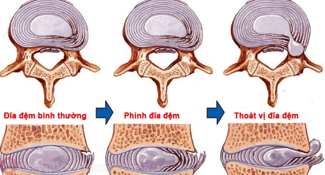 LỒI ĐĨA ĐỆM CỘT SỐNG CỔ: Thực hiện ngay 3 bài tập này! 