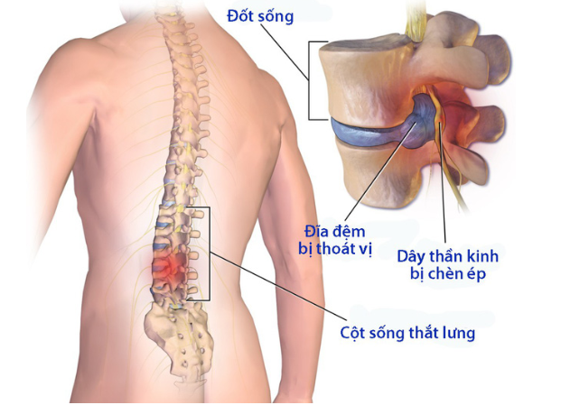 Tác dụng của các loại thảo dược với bệnh thoát vị đĩa đệm như thế nào? TS Vũ Thị Khánh Vân tư vấn