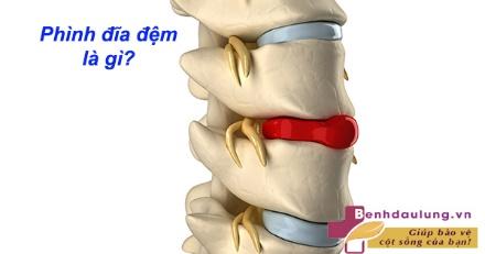 Chữa phồng đĩa đệm L3- L4 như thế nào? Đọc ngay! 