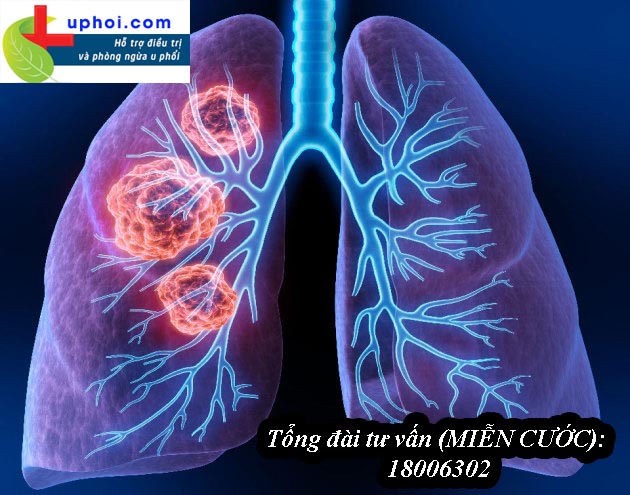 8 dấu hiệu nhận biết ung thư phổi giai đoạn đầu và phương pháp điều trị hiệu quả!