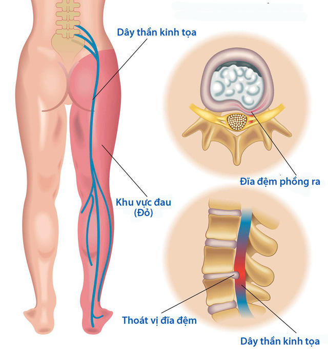 Biểu hiện đau dây thần kinh tọa như thế nào? PGS. TS Dương Trọng Hiếu giải đáp