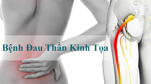 Nguyên nhân gây đau dây thần kinh tọa là gì? PGS. TS Dương Trọng Hiếu giải đáp