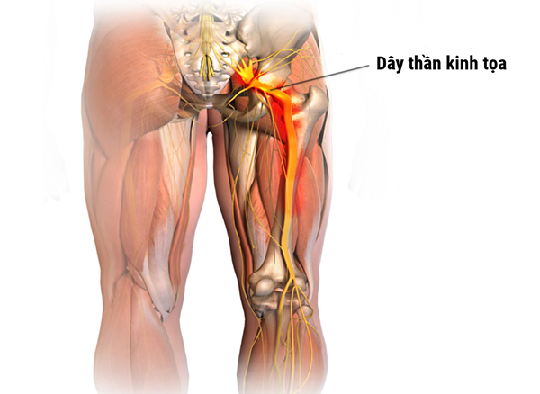 Tình trạng đau dây thần kinh tọa ở phụ nữ đang mang thai có nguy hiểm không?