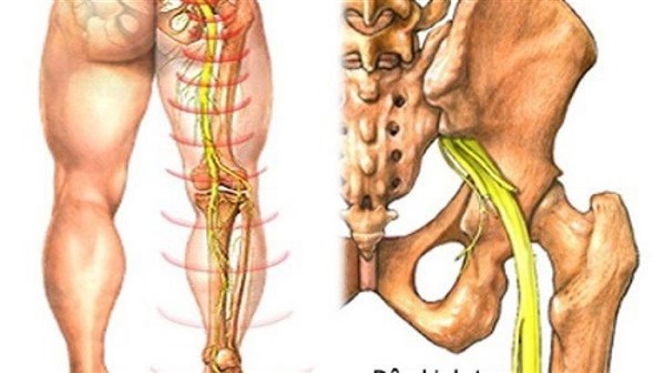 Người bị đau dây thần kinh tọa nên có chế độ luyện tập như thế nào? PGS. TS Dương Trọng Hiếu tư vấn