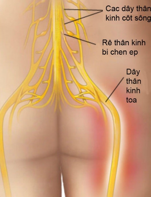 Bệnh đau dây thần kinh tọa cấp tính và mạn tính như thế nào? PGS. TS Dương Trọng Hiếu giải đáp