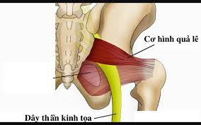 Chẩn đoán và điều trị bệnh đau dây thần kinh tọa như thế nào? Chuyên gia Dương Trọng Hiếu phân tích