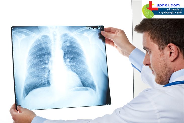 Những câu hỏi thường gặp về ung thư phổi giai đoạn 3!