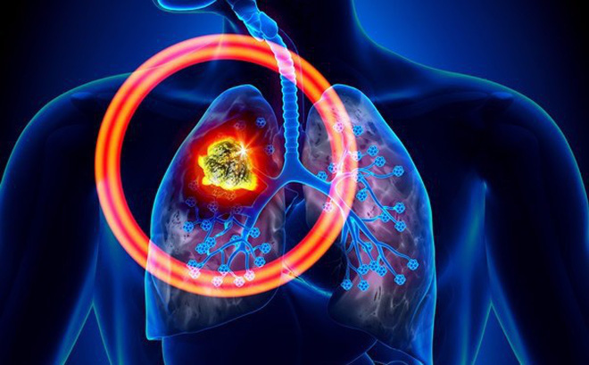 Sự khác nhau giữa u phổi với các loại u khác là gì?