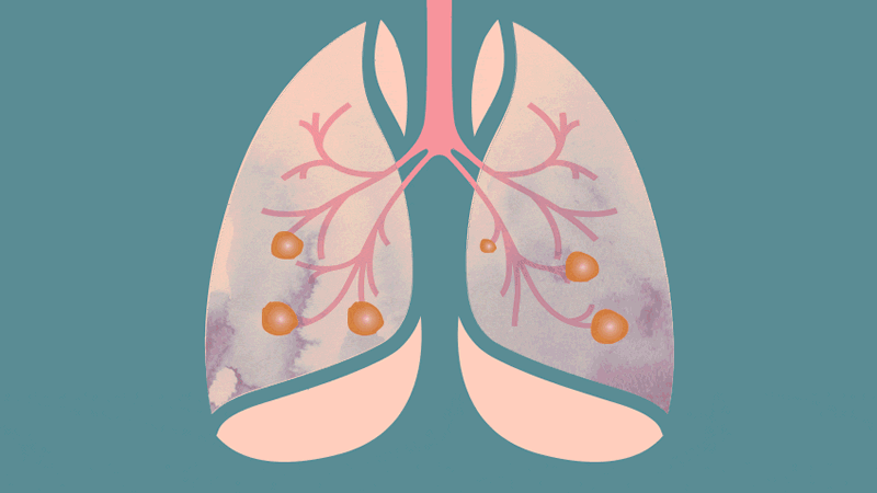 Việc kết hợp Lunatumo cùng các thảo dược khác đem lại hiệu quả hỗ trợ điều trị u phổi như thế nào?