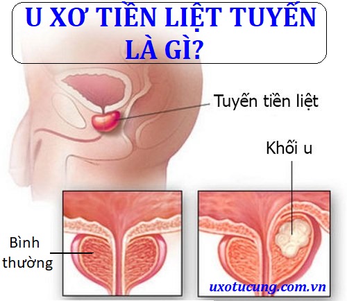 U xơ tiền liệt tuyến là gì và cách chữa trị ra sao? – ĐỌC NGAY