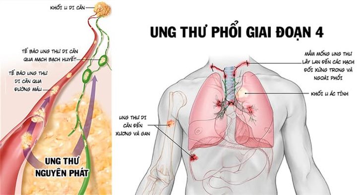 Ung thư phổi di căn hạch diễn ra như thế nào? Phương pháp điều trị hiệu quả là gì?