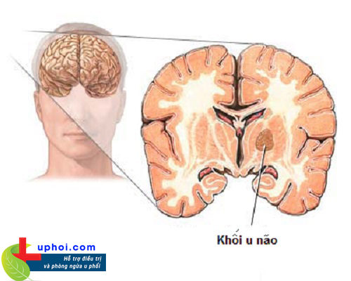 Ung thư phổi di căn não là tình trạng như thế nào và điều trị ra sao?