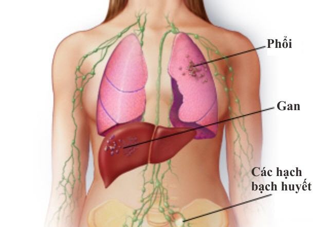 Ung thư phổi di căn gan – Biểu hiện và phương pháp điều trị hiệu quả.