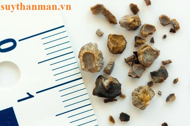 Sỏi thận 10mm lớn hay nhỏ, có nguy hiểm không?