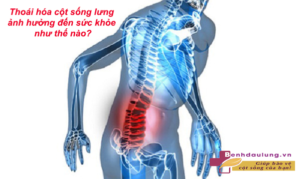 Thoái hóa cột sống lưng có dùng được Cốt Thoái Vương không? 