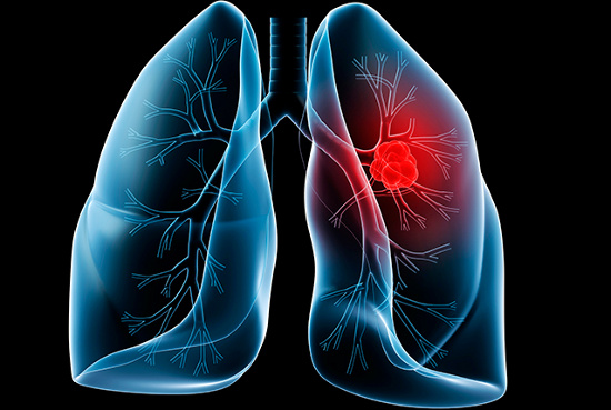 Bị u phổi lành tính sống được bao lâu và có điều trị khỏi được không?