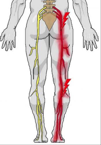 Tình trạng đau nhức từ hông xuống bắp chân có phải biểu hiện đau dây thần kinh tọa không?