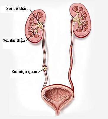 Điều trị sỏi niệu quản như thế nào? Chuyên gia Nguyễn Hồng Hải tư vấn