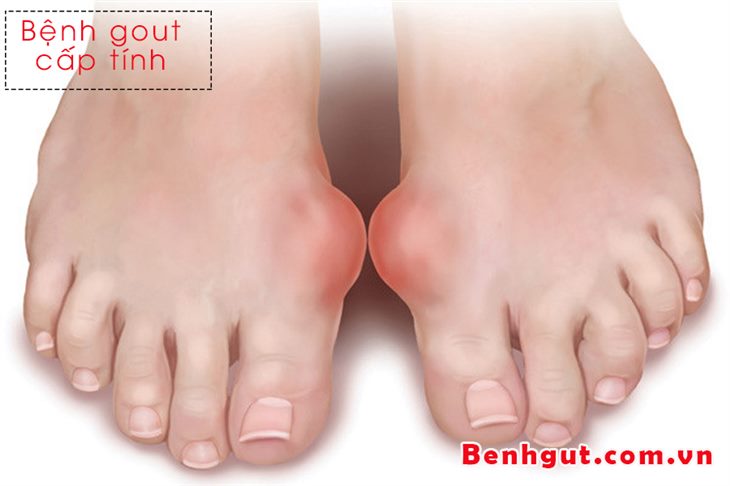 Giải pháp hỗ trợ điều trị bệnh gout cấp hiệu quả nhờ Hoàng Thống Phong