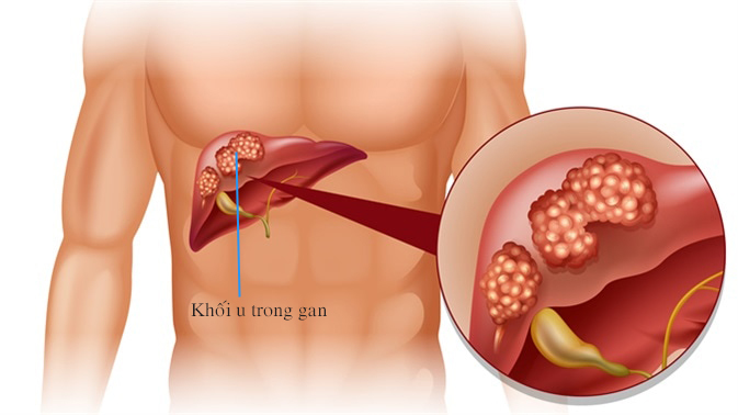 Chế độ ăn uống hợp lý giúp ngăn ngừa u gan ác tính. XEM NGAY!