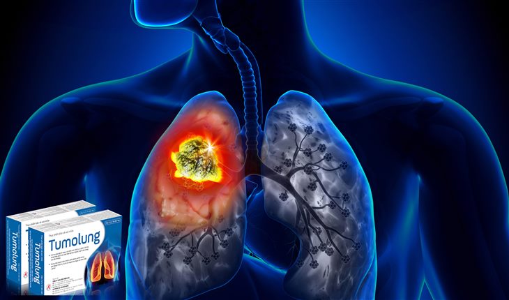 Tại sao nên sử dụng Tumolung để hạn chế tác dụng phụ khi hóa trị u phổi ác tính?
