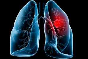 U phổi lành tính có đau không và có nguy hiểm không?