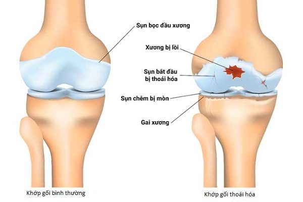 Người trẻ tuổi nên vận động như thế nào để tránh bị thoái hóa khớp?