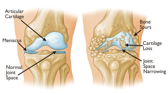 Nếu phát hiện triệu chứng thoái hóa khớp thì phải làm sao? Chuyên gia Nguyễn Hồng Hải tư vấn