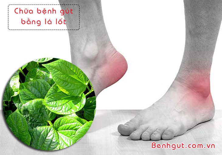  Chuyên gia hướng dẫn 4 cách chữa bệnh gout bằng lá lốt hiệu quả tại nhà