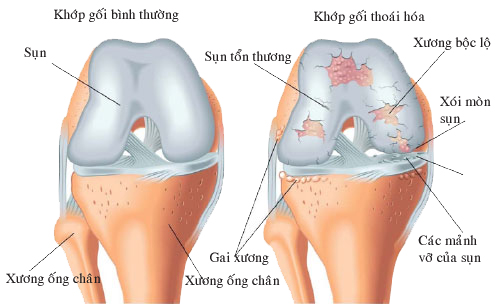 Mang giầy cao gót khiến bệnh thoái hoá khớp tiến triển như thế nào?