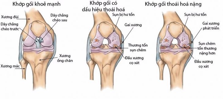 Nếu phát hiện triệu chứng thoái hóa khớp thì phải làm sao? Chuyên gia Nguyễn Hồng Hải tư vấn