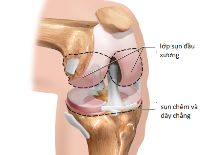 Tại sao lười vận động cũng gây ra thoái hóa khớp? Chuyên gia Nguyễn Hồng Hải tư vấn