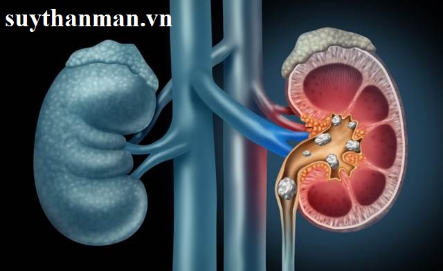 Cảnh báo: Mắc các bệnh về thận chỉ vì 6 thói quen sinh hoạt này. Click xem ngay