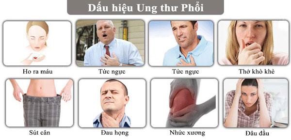 Những triệu chứng ung thư phổi có thể nhận biết sớm là gì?