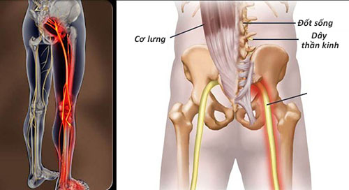 Bị xẹp đốt sống gây đau nhức khi ngồi, phải làm sao? Chuyên gia Nguyễn Hồng Hải tư vấn