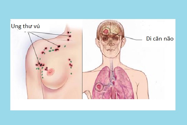 Ung thư vú di căn não - Thông tin hữu ích kéo dài tuổi thọ