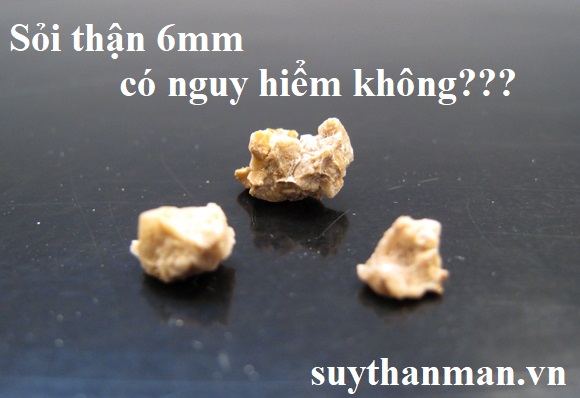 Bị sỏi thận 6mm có nguy hiểm không? Xem ngay lời giải đáp của chuyên gia TẠI ĐÂY