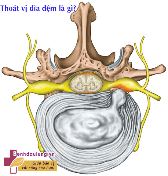 Thoát vị đĩa đệm chèn dây thần kinh có nguy hiểm không?  